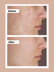 ACNE SOLUTION BUNDLE